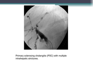 Primary sclerosing cholangitis (PSC) with multiple
intrahepatic strictures.
 