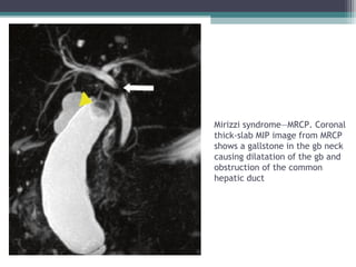 Mirizzi syndrome—MRCP. Coronal
thick-slab MIP image from MRCP
shows a gallstone in the gb neck
causing dilatation of the gb and
obstruction of the common
hepatic duct
 