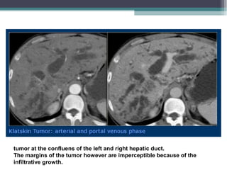 tumor at the confluens of the left and right hepatic duct.
The margins of the tumor however are imperceptible because of the
infiltrative growth.
 