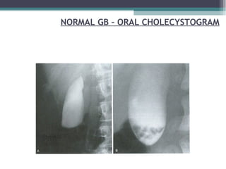 NORMAL GB – ORAL CHOLECYSTOGRAM
 