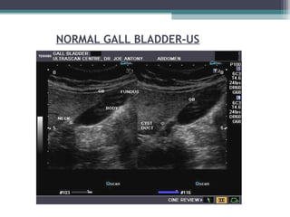 NORMAL GALL BLADDER-US
 