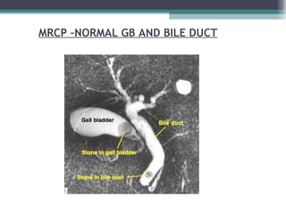 MRCP –NORMAL GB AND BILE DUCT
 