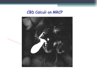 CBD Calculi on MRCP
 