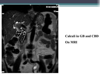 Calculi in GB and CBD
On MRI
 