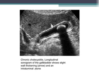 Chronic cholecystitis. Longitudinal
sonogram of the gallbladder shows slight
wall thickening (arrow) and an
intraluminal .stone
 