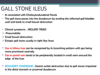GALL STONE ILEUS
• Its associated with Cholecytsoduodenal fistula
• The gall stone passes into the duodenum by eroding the inflamed gall bladder
wall and leads to small bowel obstruction
• Clinical symptoms : RIGLERS TRIAD
 Pneumobilia
 Small bowel obstruction
 Ectopic gall stone usually in right iliac fossa
 Gas in biliary tree can be recognised by its branching pattern with gas being
more prominent centrally
 Gas in portal vein tends to be peripherally located in small veins around the
edge of the liver
 BOUVERET SYNDROME : Gastric outlet obstruction due to gall stones impacted
in the distal stomach or proximal duodenum
 