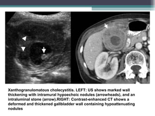 Xanthogranulomatous cholecystitis. LEFT: US shows marked wall
thickening with intramural hypoechoic nodules (arrowheads), and an
intraluminal stone (arrow).RIGHT: Contrast-enhanced CT shows a
deformed and thickened gallbladder wall containing hypoattenuating
nodules
 