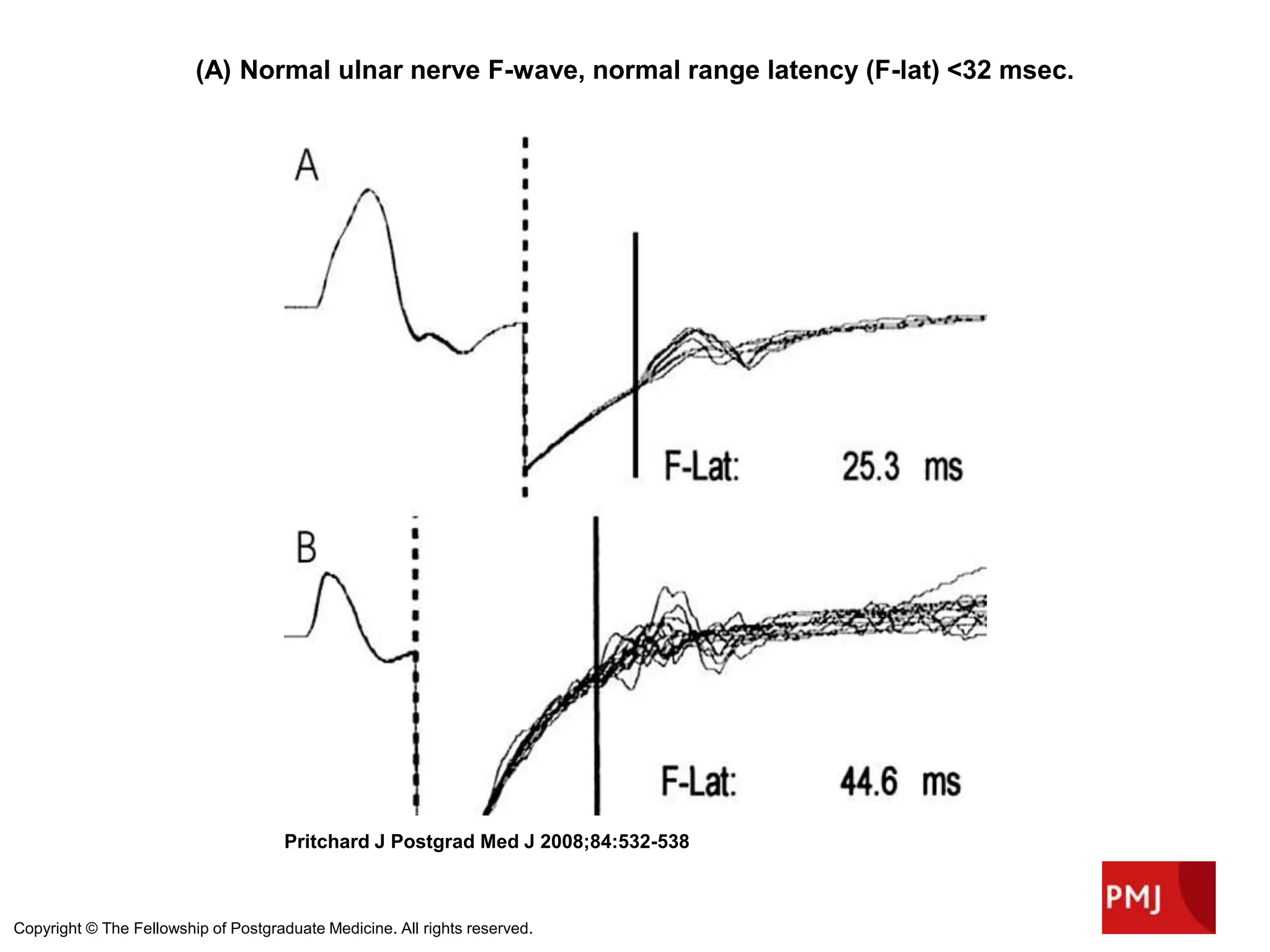 (A) Normal ulnar nerve F-wave, normal range latency (F-lat) <32 msec.
Pritchard J Postgrad Med J 2008;84:532-538
Copyright © The Fellowship of Postgraduate Medicine. All rights reserved.
 