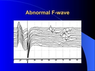 Abnormal F-wave 