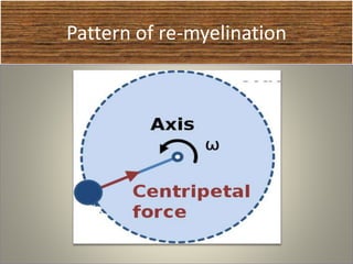 Pattern of re-myelination
 