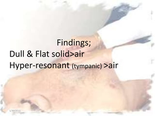 Findings;
Dull & Flat solid>air
Hyper-resonant (tympanic) >air
1/30/2015 50
 