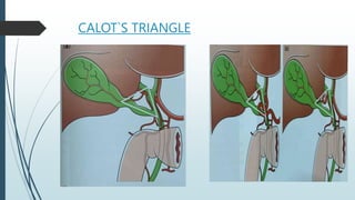 Triangle Callot Gall bladder stone disease surgical perspective | PPTX
