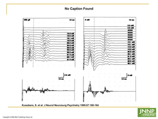 Copyright ©1999 BMJ Publishing Group Ltd.
Kuwabara, S. et al. J Neurol Neurosurg Psychiatry 1999;67:180-184
No Caption Found
 