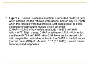  Figure 2 Soleus H-reflexes in patient 4 recorded on day 8 (left)
when achilles tendon reflexes were absent and on day 40 (right)
when the reflexes were hyperactive. Left traces: peak to peak
amplitude of compound muscle action potential
(CMAP) = 0.742 mV; H-reflex amplitude = 0.571 mV; H/M
ratio = 0.77. Right traces: CMAP amplitude=1.724 mV; H reflex
amplitude=0.785 mV; H/M ratio=0.46. Note the increased H/M
ratio despite the marked reduction in the CMAP in the left traces
(normal mean (SD) of H/M ratio, 0.17 (SD 0.08)). Lowest traces:
superimposed responses.
 