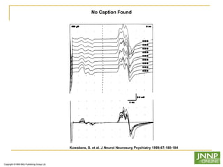 Copyright ©1999 BMJ Publishing Group Ltd.
Kuwabara, S. et al. J Neurol Neurosurg Psychiatry 1999;67:180-184
No Caption Found
 