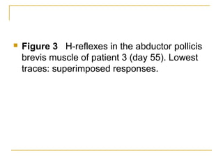  Figure 3 H-reflexes in the abductor pollicis
brevis muscle of patient 3 (day 55). Lowest
traces: superimposed responses.
 