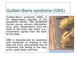 Guillain-Barre syndrome (GBS) Guillain-Barre syndrome (GBS) is an inflammatory disorder of the peripheral nerves. The peripheral nerves convey sensory information (e.g., pain, temperature) from the body to the brain and motor (i.e., movement) signals from the brain to the body.  GBS is characterized by weakness and numbness or tingling in the legs and arms, and possible loss of movement and feeling in the legs, arms, upper body, and face. 