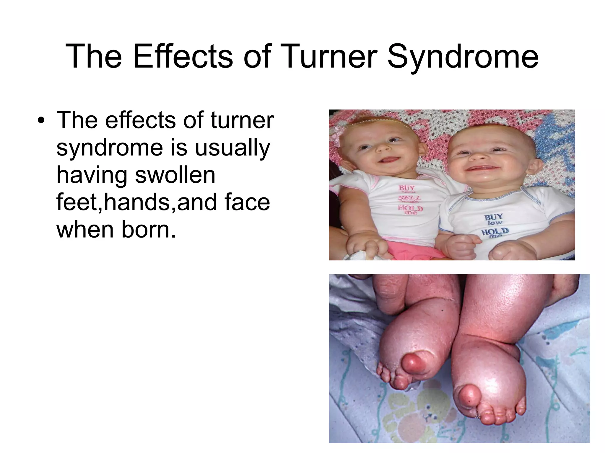 The Effects of Turner Syndrome
●
The effects of turner
syndrome is usually
having swollen
feet,hands,and face
when born.