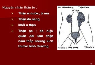 12
Nguyên nhân thận to :
 Thận ứ nước, ứ mủ
 Thận đa nang
 khối u thận
 Thận sa : do niệu
quản dài làm thận
nằm thấp nhưng kích
thước bình thường
 