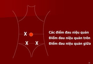 15
Các điểm đau niệu quản
Điểm đau niệu quản trên
Điểm đau niệu quản giữa
 