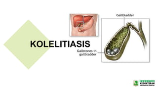 KOLELITIASIS
 