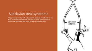 Subclavian steal syndrome
The proximal part of left subclavian is blocked on left side so no
flow in vertebral and to left arm. Blood from right vertebral
enters left vertebral and flows back to supply left arm
 