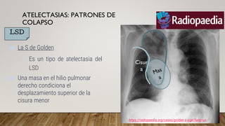 Signos radiograficos en el torax del adulto | PPTX