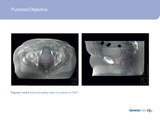 Research into the effectiveness of daily image guided radiotherapy on ...