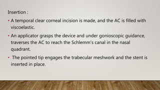 Insertion :
• A temporal clear corneal incision is made, and the AC is filled with
viscoelastic.
• An applicator grasps the device and under gonioscopic guidance,
traverses the AC to reach the Schlemm's canal in the nasal
quadrant.
• The pointed tip engages the trabecular meshwork and the stent is
inserted in place.
 