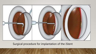 Surgical procedure for implantation of the iStent
 