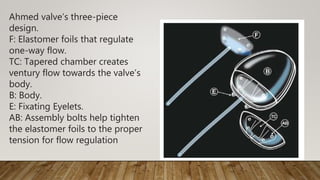 Ahmed valve’s three-piece
design.
F: Elastomer foils that regulate
one-way flow.
TC: Tapered chamber creates
ventury flow towards the valve’s
body.
B: Body.
E: Fixating Eyelets.
AB: Assembly bolts help tighten
the elastomer foils to the proper
tension for flow regulation
 