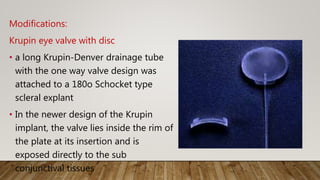 Modifications:
Krupin eye valve with disc
• a long Krupin-Denver drainage tube
with the one way valve design was
attached to a 180o Schocket type
scleral explant
• In the newer design of the Krupin
implant, the valve lies inside the rim of
the plate at its insertion and is
exposed directly to the sub
conjunctival tissues
 