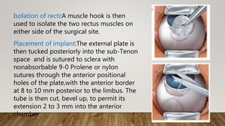 Isolation of recti:A muscle hook is then
used to isolate the two rectus muscles on
either side of the surgical site.
Placement of implant:The external plate is
then tucked posteriorly into the sub-Tenon
space and is sutured to sclera with
nonabsorbable 9-0 Prolene or nylon
sutures through the anterior positional
holes of the plate,with the anterior border
at 8 to 10 mm posterior to the limbus. The
tube is then cut, bevel up, to permit its
extension 2 to 3 mm into the anterior
chamber
 