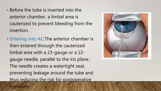 • Before the tube is inserted into the
anterior chamber, a limbal area is
cauterized to prevent bleeding from the
insertion.
• Entering into AC:The anterior chamber is
then entered through the cauterized
limbal area with a 23-gauge or a 22-
gauge needle, parallel to the iris plane .
The needle creates a watertight seal,
preventing leakage around the tube and
thus reducing the risk for postoperative
hypotony
 