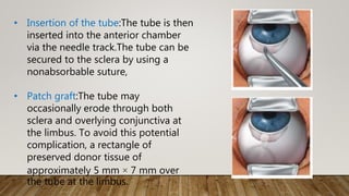 • Insertion of the tube:The tube is then
inserted into the anterior chamber
via the needle track.The tube can be
secured to the sclera by using a
nonabsorbable suture,
• Patch graft:The tube may
occasionally erode through both
sclera and overlying conjunctiva at
the limbus. To avoid this potential
complication, a rectangle of
preserved donor tissue of
approximately 5 mm × 7 mm over
the tube at the limbus.
 