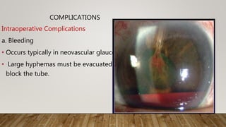 COMPLICATIONS
Intraoperative Complications
a. Bleeding
• Occurs typically in neovascular glaucoma
• Large hyphemas must be evacuated as they can
block the tube.
 