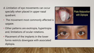 d. Limitation of eye movements can occur
specially when placed in upper nasal
quadrant.
• The movement most commonly affected is
upgaze.
• Other patterns are exotropia, hypertropia
and, limitations of ocular rotations.
• Placement of the implants in the lower
fornix restricts downgaze with associated
diplopia.
 