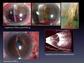 Hyphema: POD 4 and POD 35
Hypotony POD 3
Hypotony with choroidal effusion
 