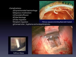-Complications:
a)Suprachoroidal haemorrhage
b)Aqueous misdirection
c)Choroidal effusion
d)Tube blockage
e)Tube migration
f)Implant migration
g)Corneal ulcer , hyphema and endophthalmitis.
 