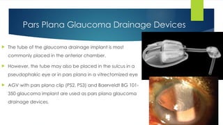 Pars Device GDD Dr hari.pptx powerpoint presentation | PPTX
