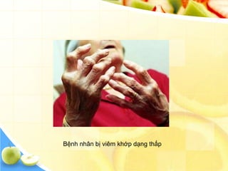 Bệnh nhân bị viêm khớp dạng thấp
 
