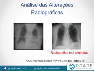 pcarefisioterapia.com.br/pcarefisioterapia
Análise das Alterações
Radiográficas
Radiografias mal alinhadas
www.cedav.com.br/arquivos/Avaliacao_Rad_Torax.doc
 