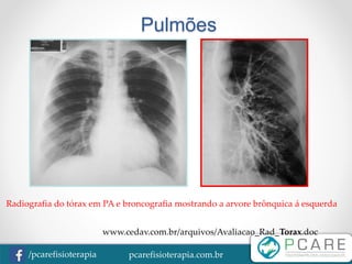 pcarefisioterapia.com.br/pcarefisioterapia
Pulmões
Radiografia do tórax em PA e broncografia mostrando a arvore brônquica á esquerda
www.cedav.com.br/arquivos/Avaliacao_Rad_Torax.doc
 