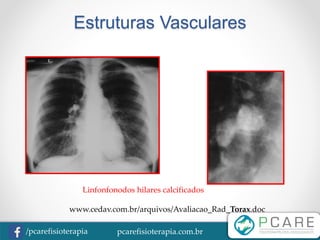 pcarefisioterapia.com.br/pcarefisioterapia
Estruturas Vasculares
Linfonfonodos hilares calcificados
www.cedav.com.br/arquivos/Avaliacao_Rad_Torax.doc
 