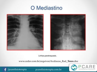 pcarefisioterapia.com.br/pcarefisioterapia
O Mediastino
Linhas paratraqueais.
www.cedav.com.br/arquivos/Avaliacao_Rad_Torax.doc
 
