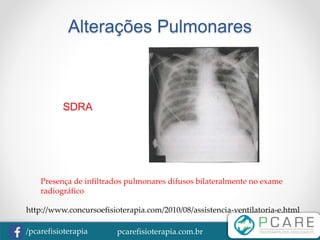 pcarefisioterapia.com.br/pcarefisioterapia
Alterações Pulmonares
SDRA
http://www.concursoefisioterapia.com/2010/08/assistencia-ventilatoria-e.html
Presença de infiltrados pulmonares difusos bilateralmente no exame
radiográfico
 