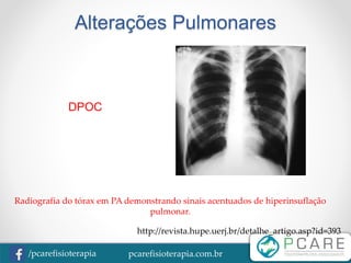 pcarefisioterapia.com.br/pcarefisioterapia
Alterações Pulmonares
DPOC
Radiografia do tórax em PA demonstrando sinais acentuados de hiperinsuflação
pulmonar.
http://revista.hupe.uerj.br/detalhe_artigo.asp?id=393
 