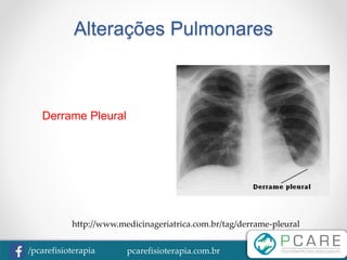pcarefisioterapia.com.br/pcarefisioterapia
Alterações Pulmonares
Derrame Pleural
http://www.medicinageriatrica.com.br/tag/derrame-pleural
 