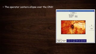 • The operator centers ellipse over the ONH
 