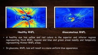 Healthy RNFL Glaucomatous RNFL
• A healthy eye has yellow and red colors in the superior and inferior regions
representing thick RNFL regions and blue and green areas nasally and temporally
representing thinner RNFL areas.
• In glaucoma, RNFL loss will result in a more uniform blue appearance
 